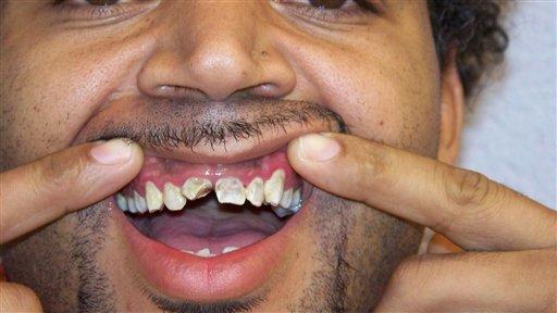 In an undated handout photo provided by attorney David Raybin, Anthony McCoy shows the damage done to his teeth after a sheriff's lieutenant at the Davidson County, Tenn. Jail allegedly ripped the gold grill off his teeth.