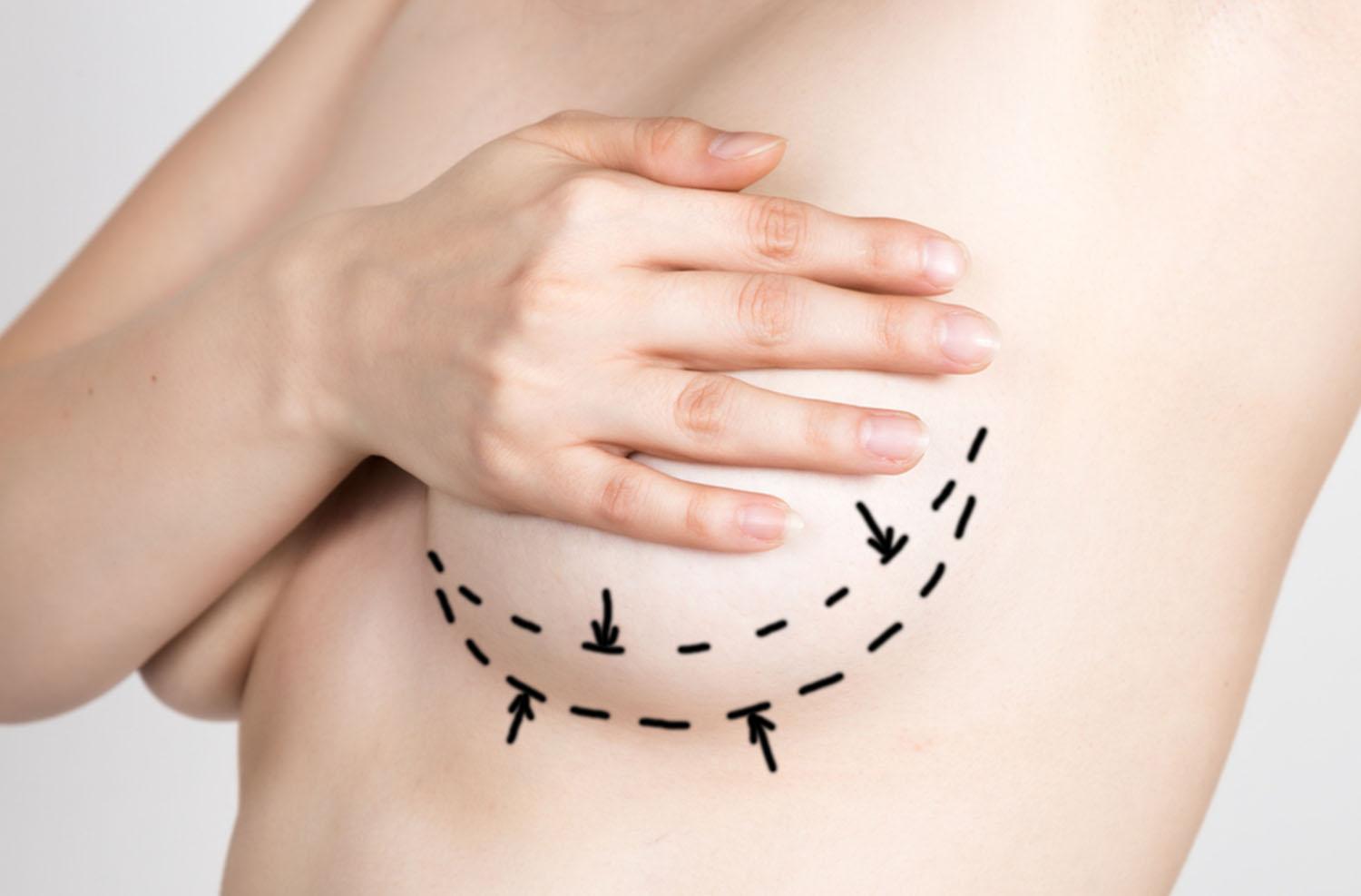 A modern mastectomy: preventing cancer without heavy scarring